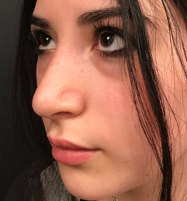 Rhinoplasty Before & After Gallery - Patient 20544065 - Image 2