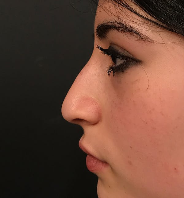 Rhinoplasty Before & After Gallery - Patient 20544065 - Image 3
