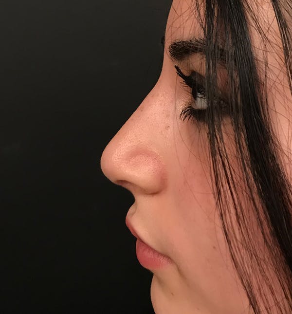 Rhinoplasty Before & After Gallery - Patient 20544065 - Image 4
