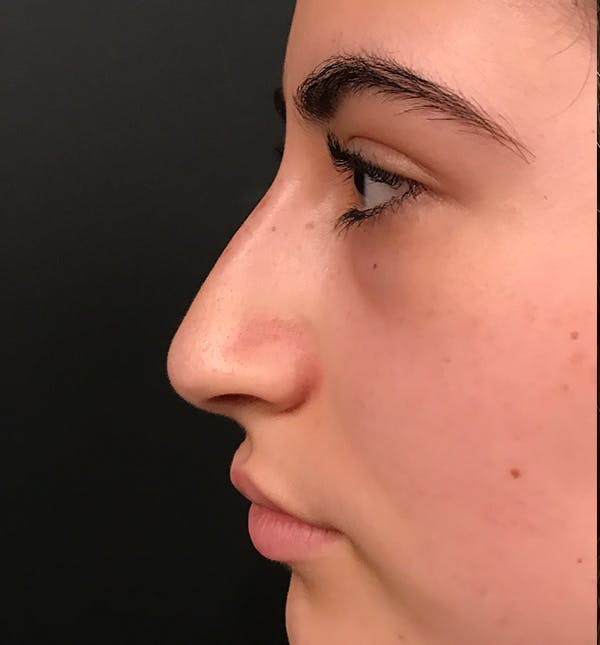 Rhinoplasty Before & After Gallery - Patient 20544066 - Image 3