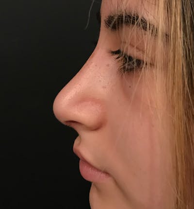 Rhinoplasty Before & After Gallery - Patient 20544066 - Image 4