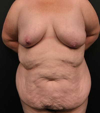 Breast Lift Mastopexy Before & After Gallery - Patient 52321425 - Image 1