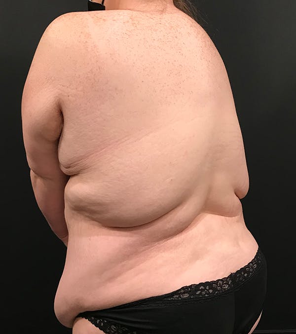 Back Lift (Bra Line Back Lift) Before and After Pictures Case 1097, Los  Angeles, CA