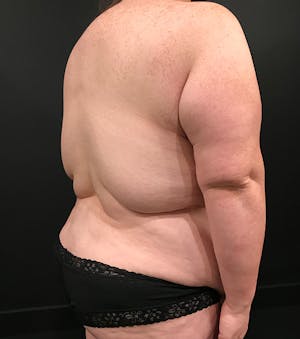 Bra line backlift correct sagging skin and excess fat around the back.