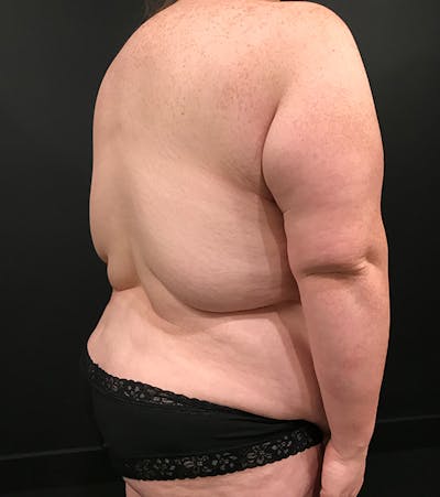 Breast Lift Mastopexy Before & After Gallery - Patient 52321425 - Image 6