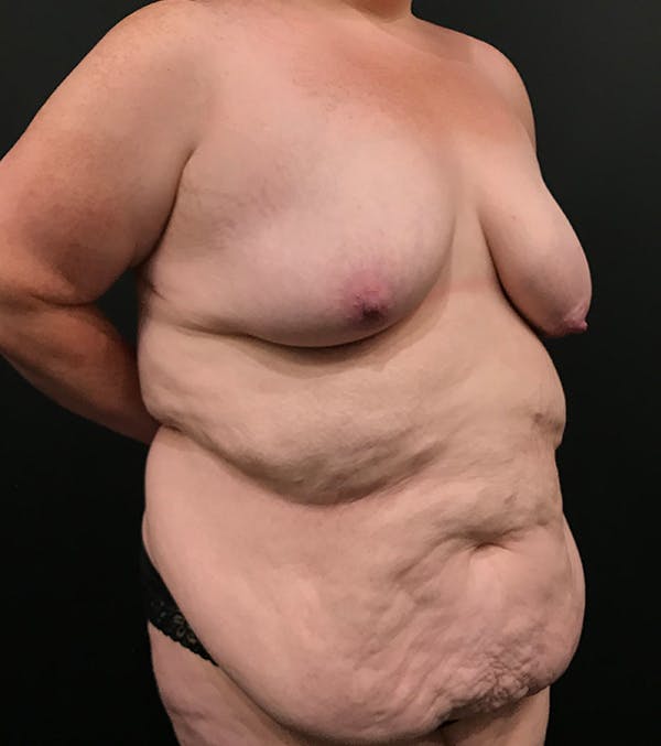 Breast Lift Mastopexy Before & After Gallery - Patient 52321425 - Image 12