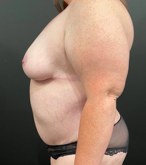 Breast Lift Mastopexy Before & After Gallery - Patient 52321425 - Image 13