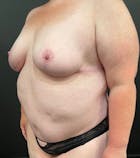 Bra Line Back Lift™ Before & After Gallery - Patient 52321438 - Image 2