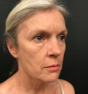 Before and After of Facelift in Scottsdale