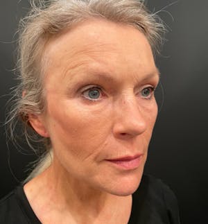 Before and After of Facelift in Scottsdale