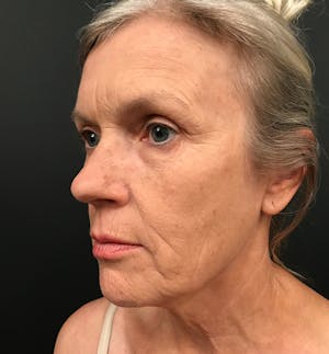Before and After of Facelift in Scottsdale
