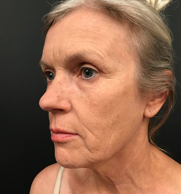 Neck Lift Before & After Gallery - Patient 83738242 - Image 9