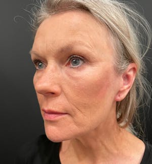 Before and After of Facelift in Scottsdale