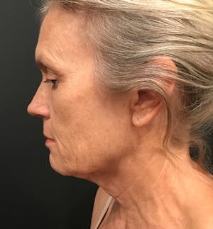 Before and After of Facelift in Scottsdale