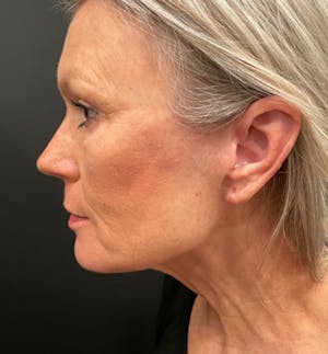 Before and After of Facelift in Scottsdale