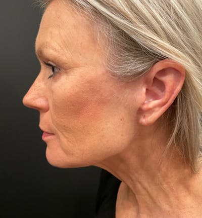 Neck Lift Before & After Gallery - Patient 83738242 - Image 8