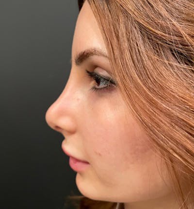 Rhinoplasty Before & After Gallery - Patient 83789838 - Image 4