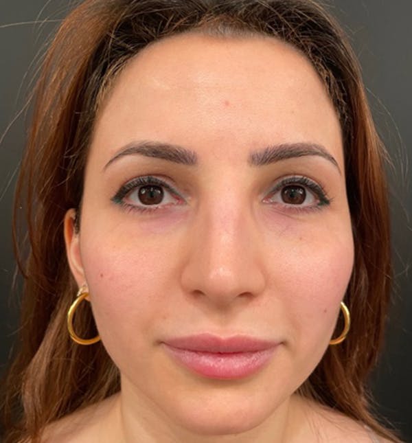 Rhinoplasty Before & After Gallery - Patient 83789838 - Image 5