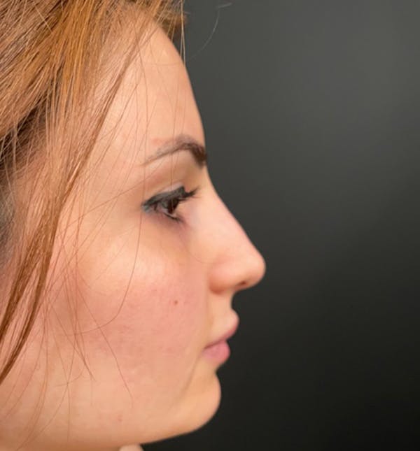 Rhinoplasty Before & After Gallery - Patient 83789838 - Image 7