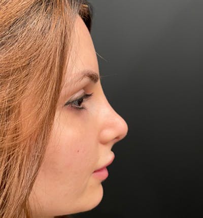 Rhinoplasty Before & After Gallery - Patient 83789838 - Image 8