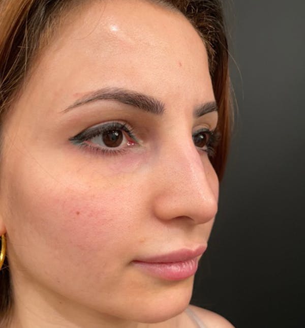 Rhinoplasty Before & After Gallery - Patient 83789838 - Image 9