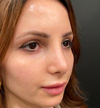 Rhinoplasty Before & After Gallery - Patient 83789838 - Image 10