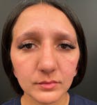 Genioplasty Before & After Gallery - Patient 86287129 - Image 2