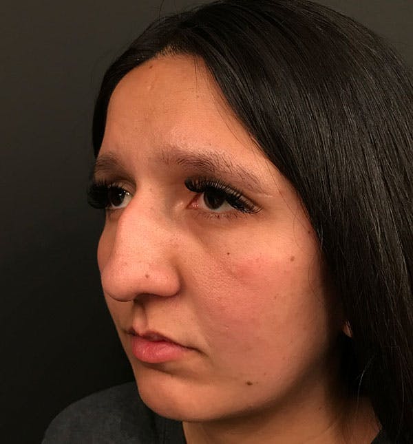 Rhinoplasty Before & After Gallery - Patient 86264345 - Image 3