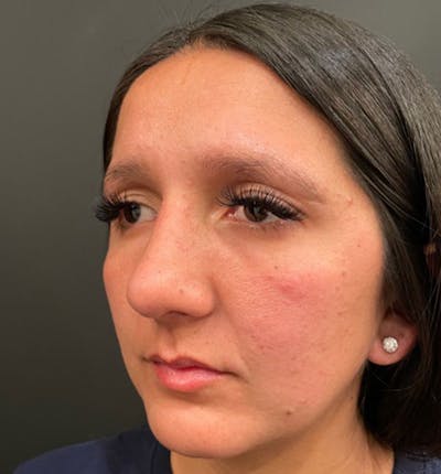 Rhinoplasty Before & After Gallery - Patient 86264345 - Image 4