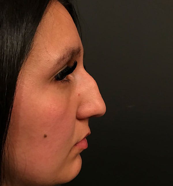 Rhinoplasty Before & After Gallery - Patient 86264345 - Image 8