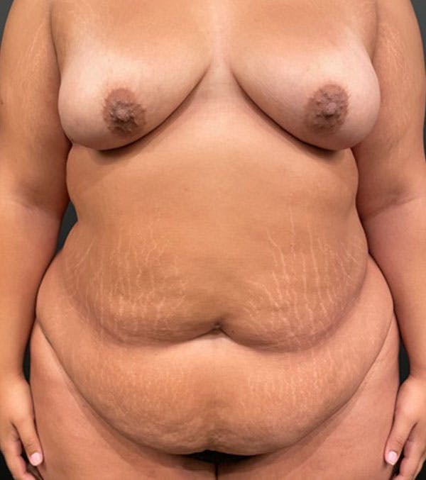 Tummy Tuck Before & After Gallery - Patient 96910018 - Image 1