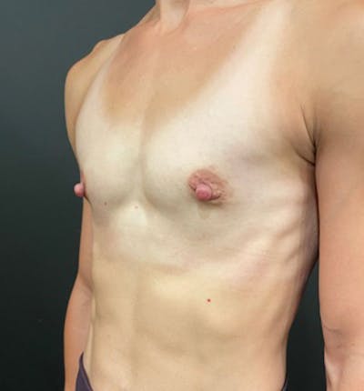 Breast Augmentation Before & After Gallery - Patient 96910936 - Image 1