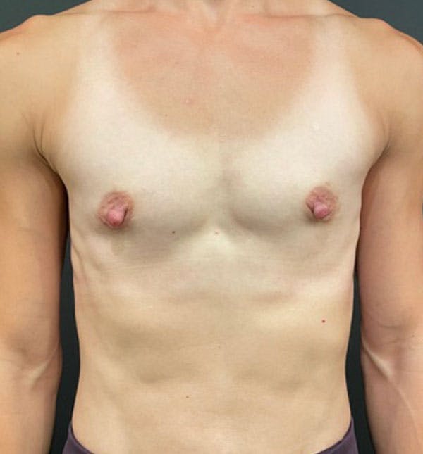 Breast Augmentation Before & After Gallery - Patient 96910936 - Image 5