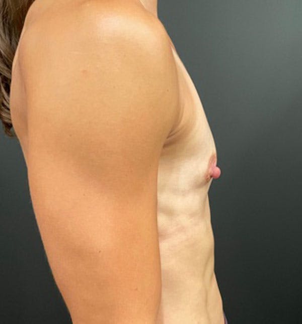 Breast Augmentation Before & After Gallery - Patient 96910936 - Image 7
