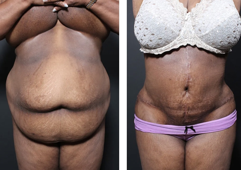 Plus Size Tummy Tuck before and after