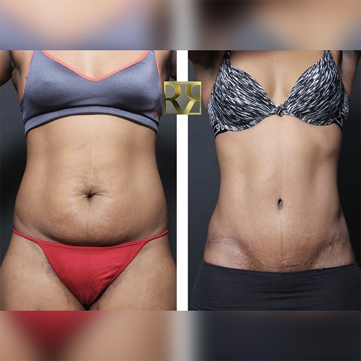 Tummy tuck before and after