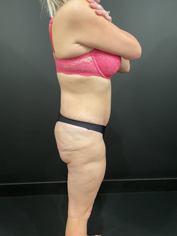 Buttock Shaping Before & After Gallery - Patient 123744606 - Image 3