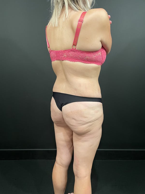 Buttock Shaping Before & After Gallery - Patient 123744606 - Image 5