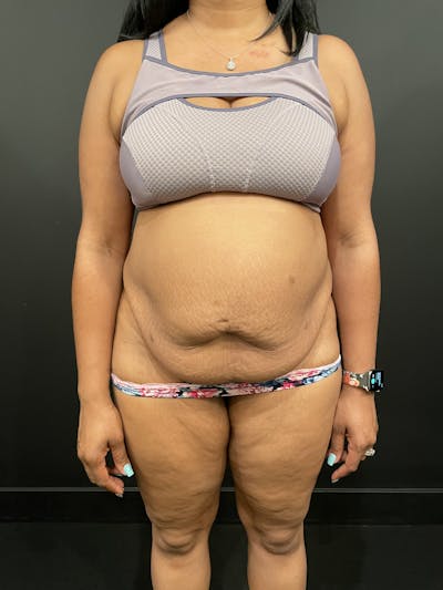 Tummy Tuck Before & After Gallery - Patient 123744635 - Image 1