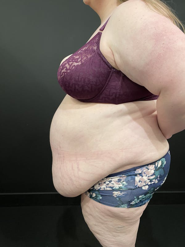 Plus Size Tummy Tuck® Before & After Gallery - Patient 123744681 - Image 7