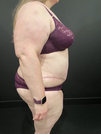Plus Size Tummy Tuck® Before & After Gallery - Patient 123744681 - Image 10