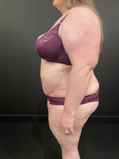 Plus Size Tummy Tuck® Before & After Gallery - Patient 123744681 - Image 8