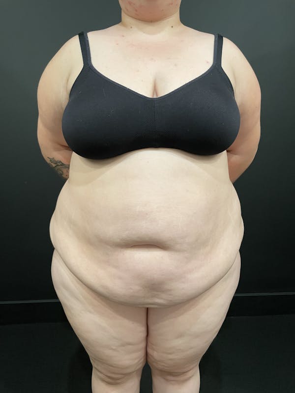 Plus Size Tummy Tuck® Before & After Gallery - Patient 123815218 - Image 1
