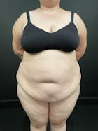 Plus Size Tummy Tuck® Before & After Gallery - Patient 123815218 - Image 1