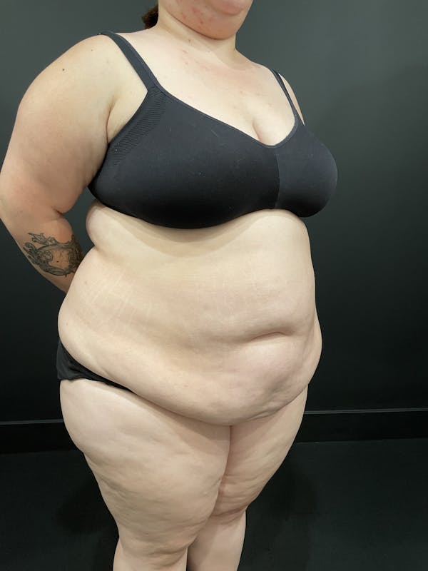 Plus Size Tummy Tuck® Before & After Gallery - Patient 123815218 - Image 3