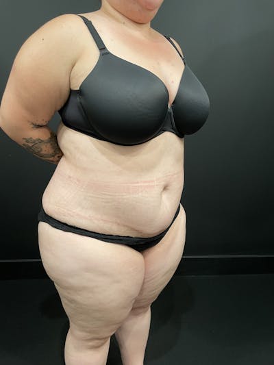 Plus Size Tummy Tuck® Gallery - Patient 123815218 - Image 4
