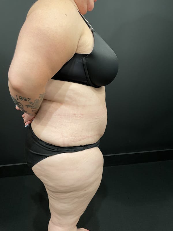 Plus Size Tummy Tuck® Before & After Gallery - Patient 123815218 - Image 6