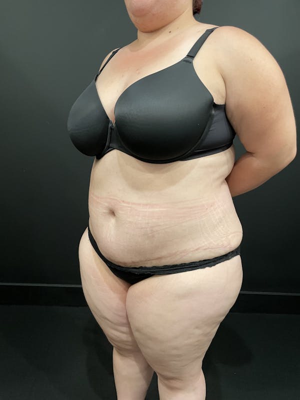 Plus Size Tummy Tuck® Gallery - Patient 123815218 - Image 8