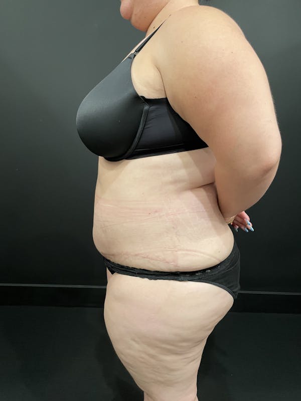 Plus Size Tummy Tuck® Gallery - Patient 123815218 - Image 10