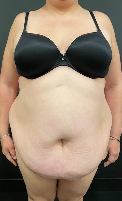 Plus Size Tummy Tuck: Day After Surgery Before & After Gallery - Patient 117399 - Image 1